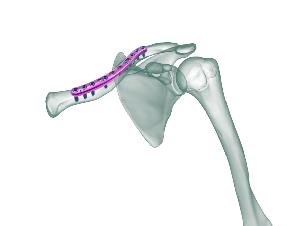 Clavicle Locking Plate